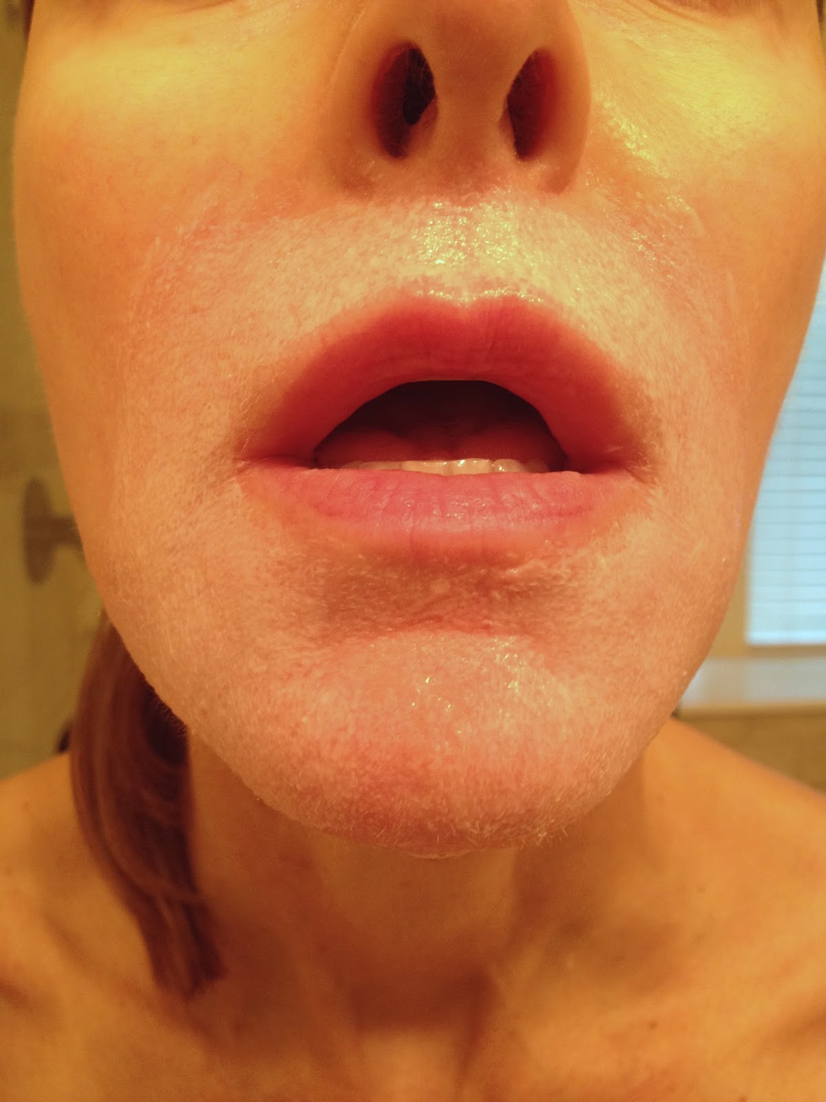 Chemical Peels for Acne and Anti Aging Significantly Reduce Redness