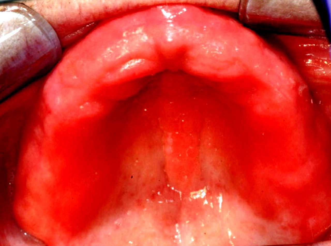 Denturerelated stomatitis