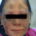 Recent Treatment For Vitiligo : Numerous Reasons Of Early Menopause