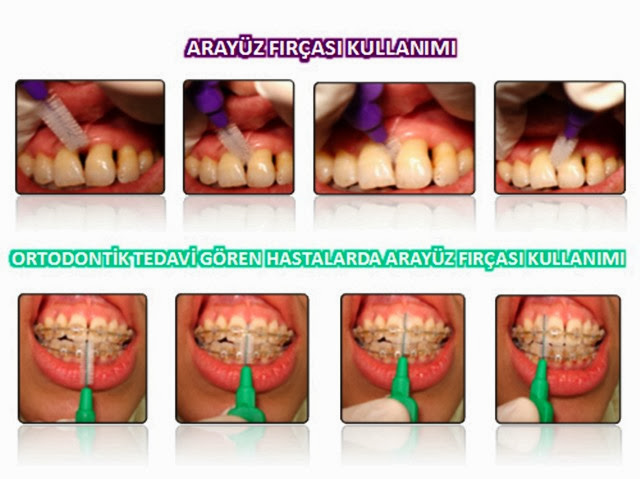 Periodontal Küretaj Ve Flap Süreci Alisveris Guncesi