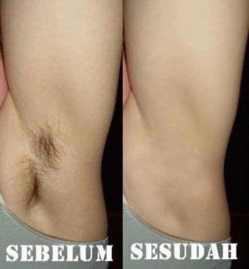 Hasil Penghilang Bulu Rambut Dodora All Gone Hair Removal Cream Hasil Penghilang Bulu Rambut Dodora All Gone Hair Removal Cream