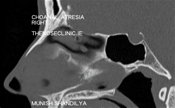Choanal Atresia