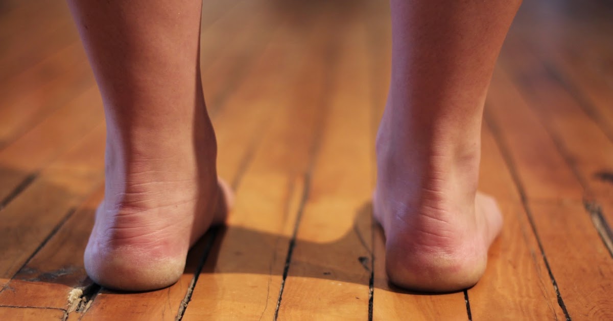 swollen feet wearing heels