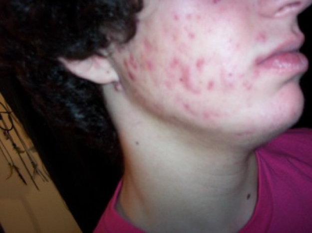 accutane treatment nodular