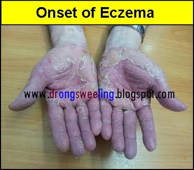 Steroid cream for eczema singapore
