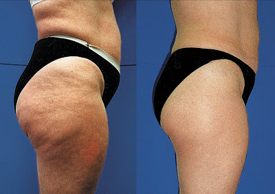Causes of cellulite, anti cellulite treatments and solutions Causes of cellulite, anti cellulite treatments and solutions