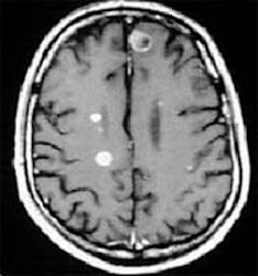 mri white spots