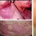 Obat Gatal Eksim di Lengan