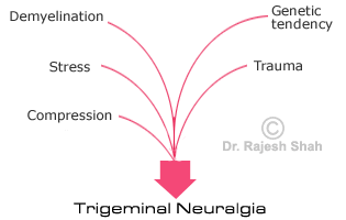 articles on trigeminal neuralgia articles on trigeminal neuralgia