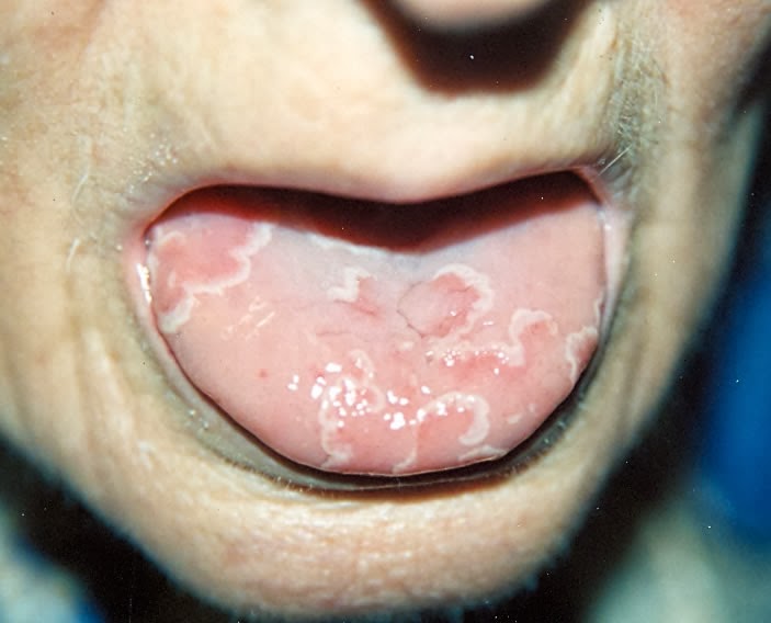 ¿estoy deprimida? Blog de clase 2º PCPI Laura Delgado: El escorbuto