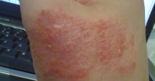 Eczema Symptoms Pictures Eczema Treatment Eczema Eczema Symptoms Pictures Eczema Treatment Eczema