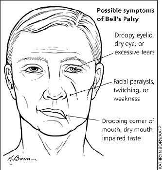 Facial nerve palsy steroid treatment