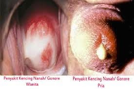 Obat Kencing Nanah Alami Manjur