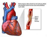 Penyebab Penyakit Jantung