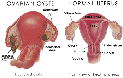 CYSTS OVARI