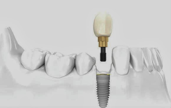 New Teeth Implants