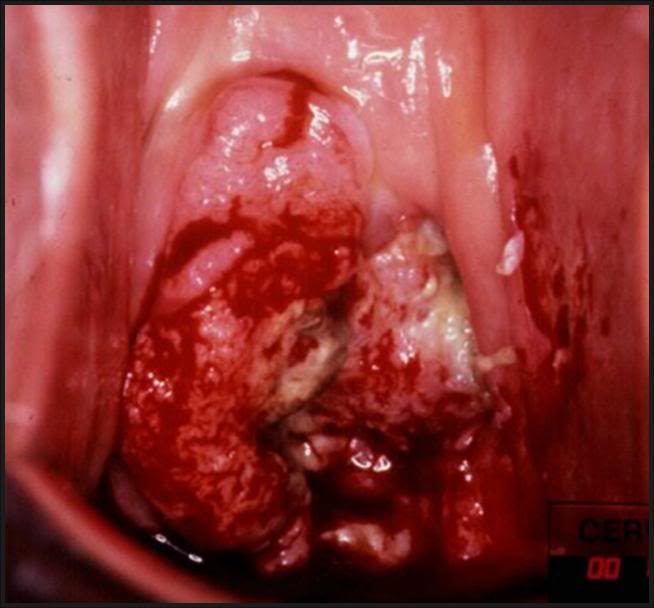 Cervix Lump