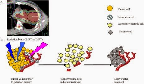  Effect of radiation theraphy