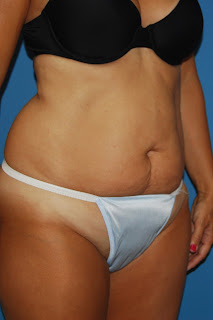tummy abdominoplasty abdomen