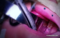 Oral intubation in general anesthesia for dental treatment Oral intubation general anesthesia dental treatment