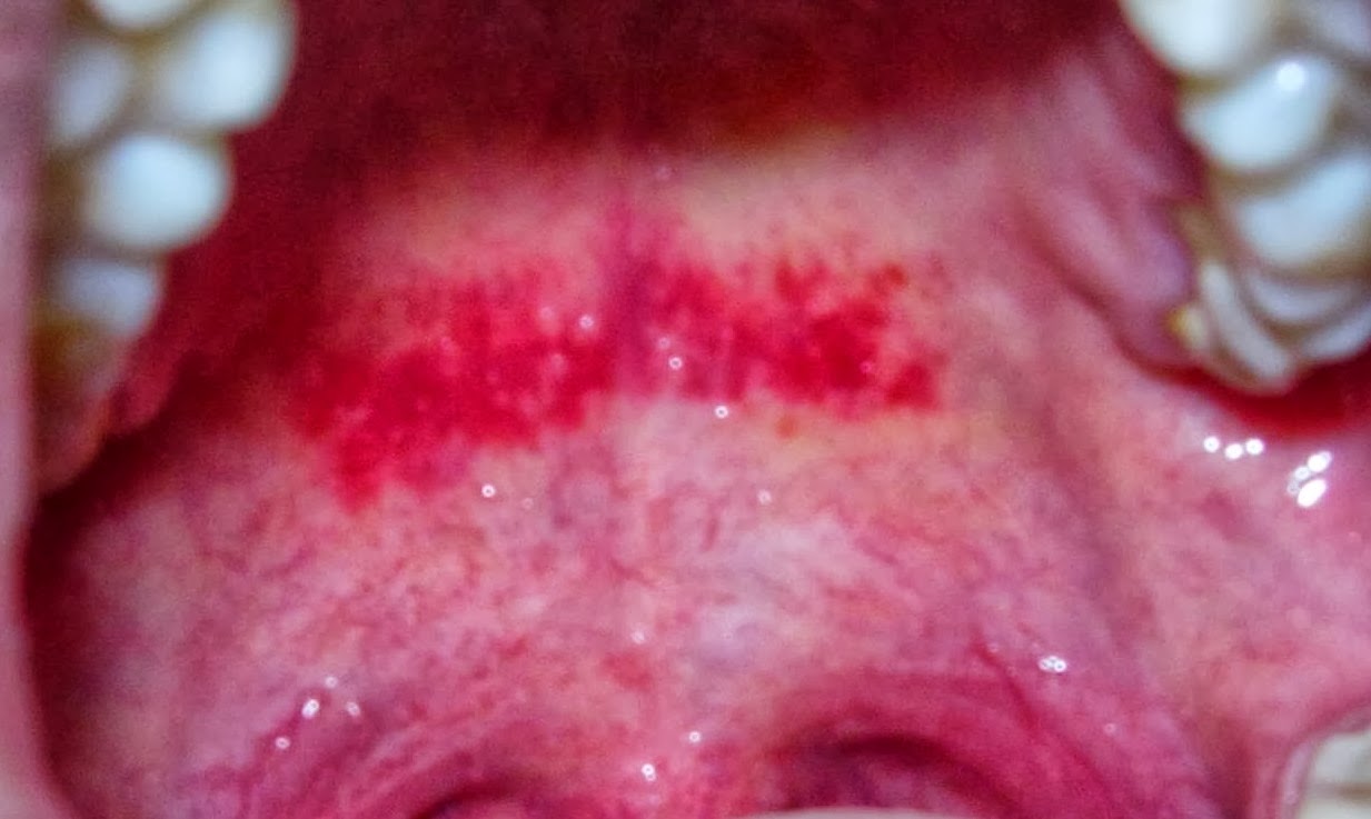 Rough Red Patch On Roof Of Mouth