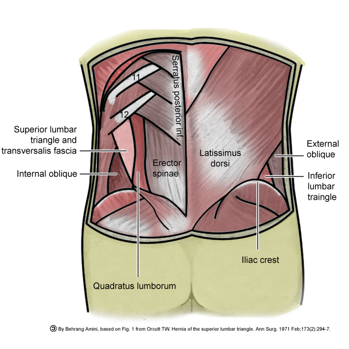 Medi Photos Illustration of Lumbar Hernia