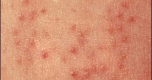 Dermatitis atopica axilas_3