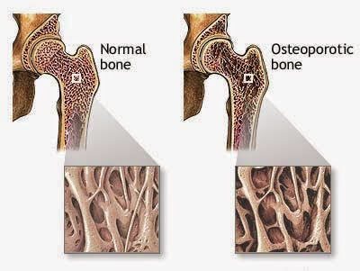 Obat Kanker Tulang Tradisional Terumtakhir Yang Aman
~
Blog Informasi Kita Semua