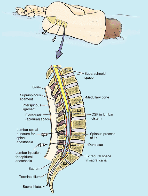 What Is A Blood Patch For Spinal Headache
