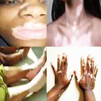 Treatment Vitiligo Aiims : What Is Hypoactive Thyroid - Causes, Symptoms And Treatments