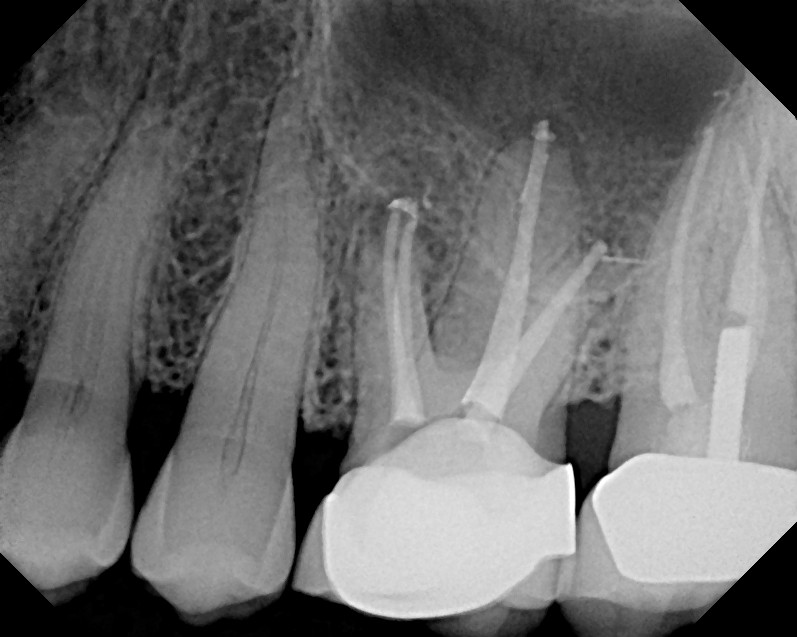 The Endo Blog Persistent PostTreatment (Apical) Periodontitis.