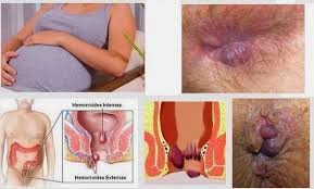 Ambein Buat Ibu Hamil Ambein Buat Ibu Hamil