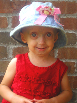 Disease Progeria