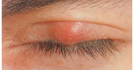 Cara Paling Ampuh Menghilangkan Bintitan Pada Mata | Irham Ma�ruf