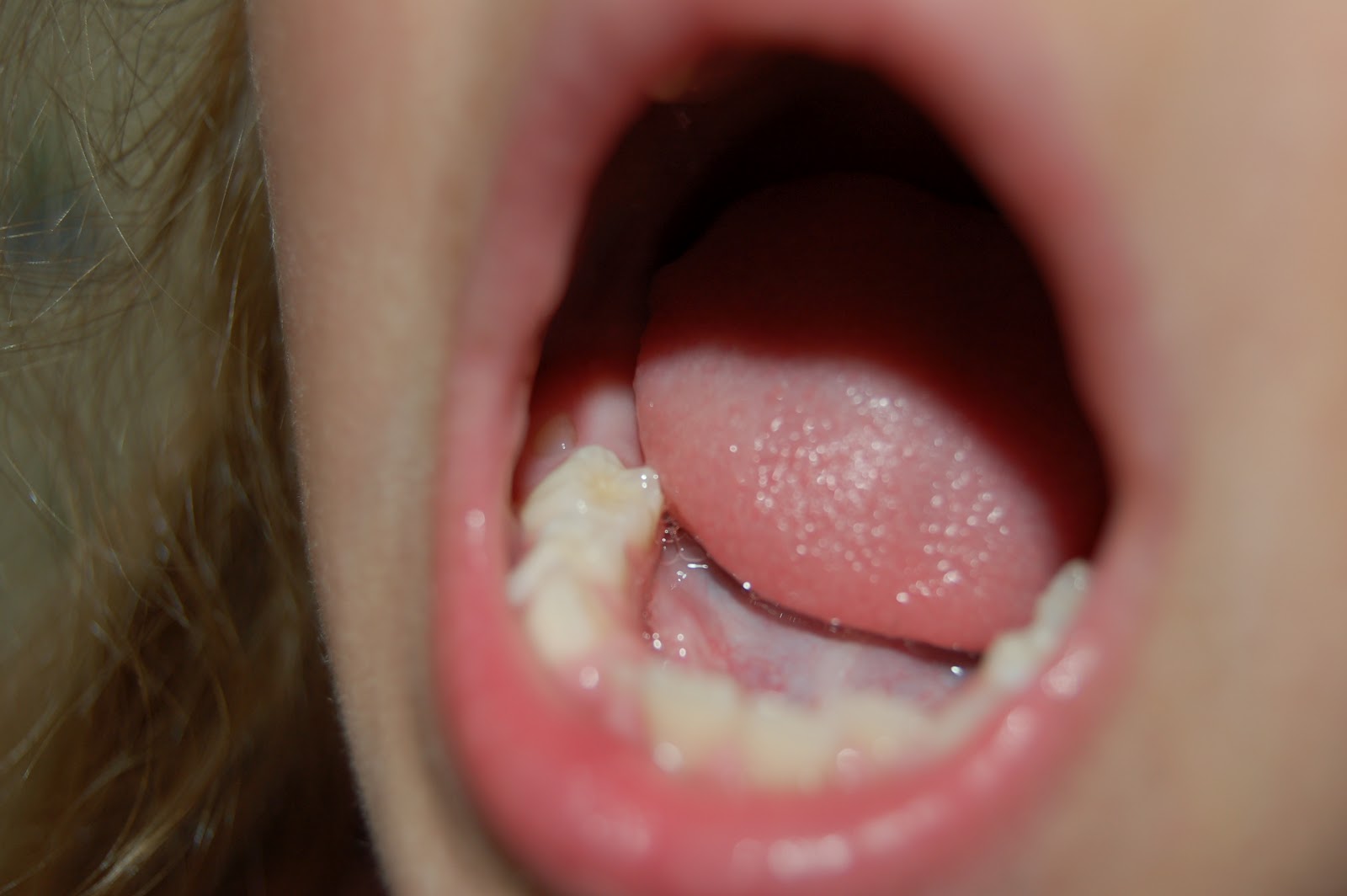 Piper's Blog: 6-year molars are coming in!