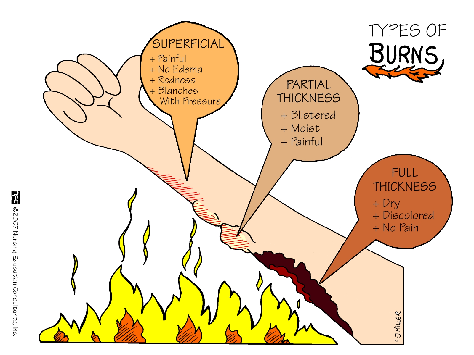Types+Of+Burns. Types+Of+Burns