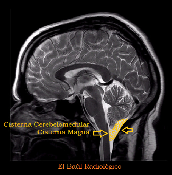 КСС. Череп. Sinus Pericranii (с). Идиопатический внутричерепной