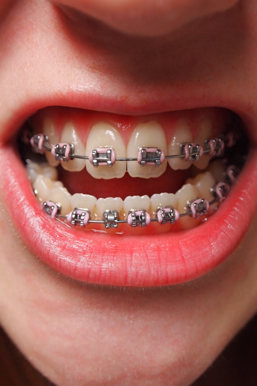 Rosa's Jaw Surgery Story 8 months of braces