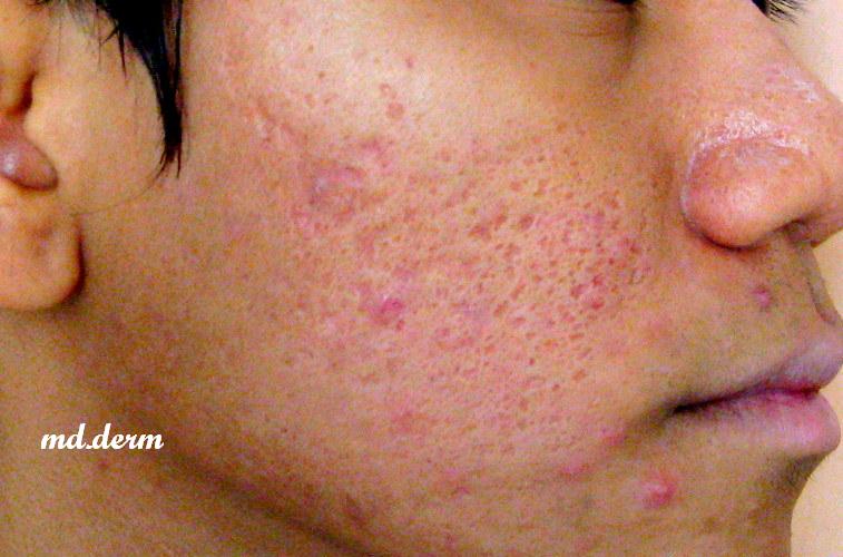 Acne vulgaris