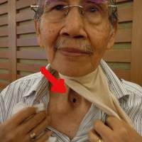 Smokers Neck