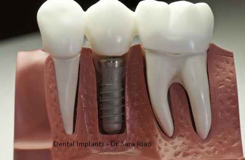 Dental Implants Covina