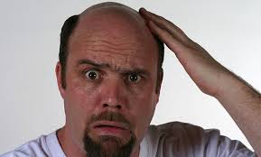 Literally Speaking Men Stop Losing Your Mind Over Hair Loss