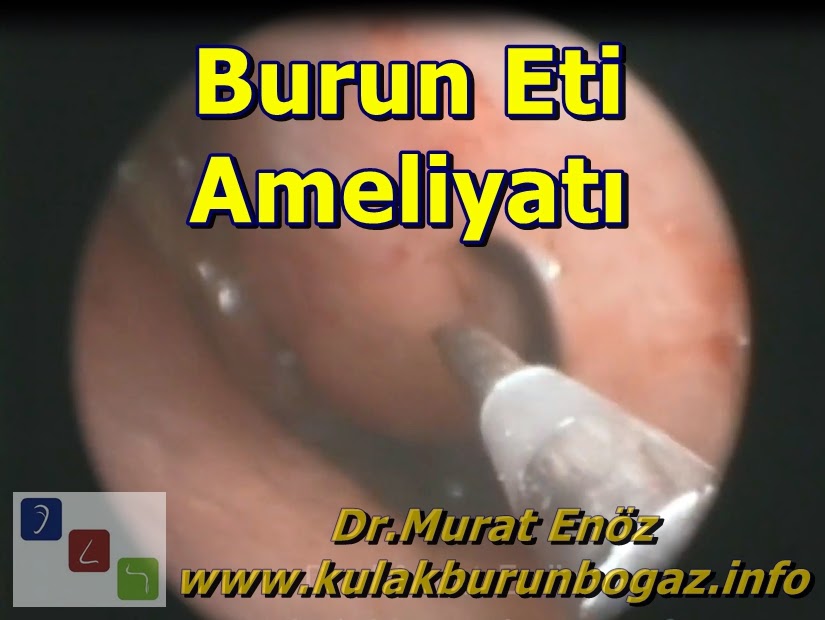 Burun Eti Ameliyatı KBB Uzmanı Bakırköy