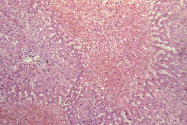 what is pulmonary vascular congestion