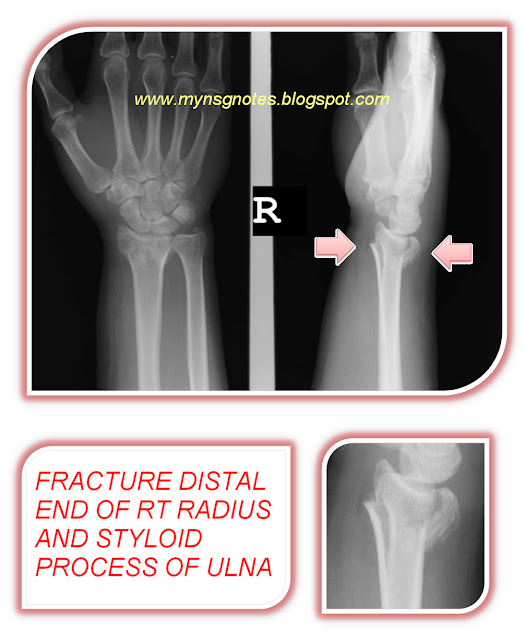 Radial Fracture FRACTURE DISTAL END OF RT RADIUS AND STYLOID PROCESS OF ULNA-3.bp.blogspot.com