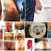 Obat Wasir (Hemoroid) Tradisional Mujarab thumbnail