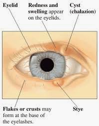 Side effects of topical steroids eye drops