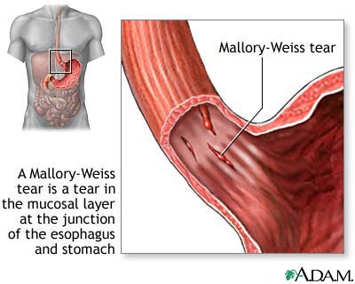the clinical description of angina and its cure Angina pectoris is the result of myocardial ischemia caused by an imbalance between myocardial blood supply and oxygen demand angina is. the clinical description of angina and its cure Angina pectoris is the result of myocardial ischemia caused by an imbalance between myocardial blood supply and oxygen demand angina is.