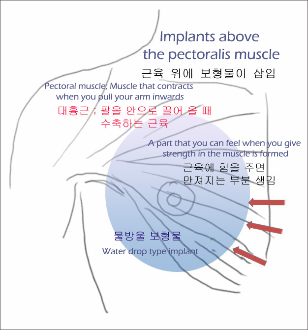Dr. Lee Breast augmentation Korea Dual plane teardrop breast augmentation Korea KIESU