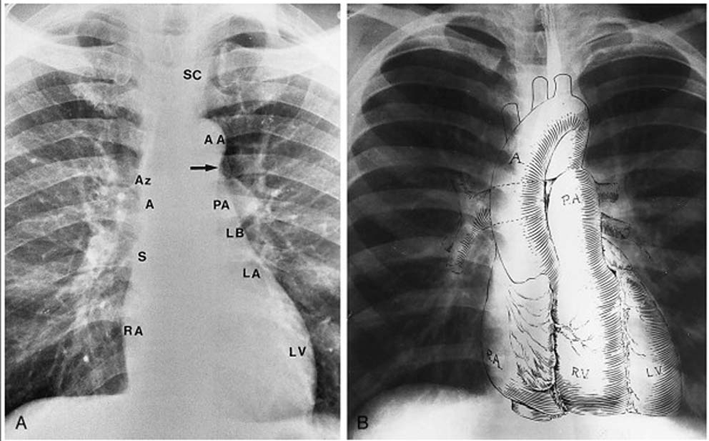 cardiac borders